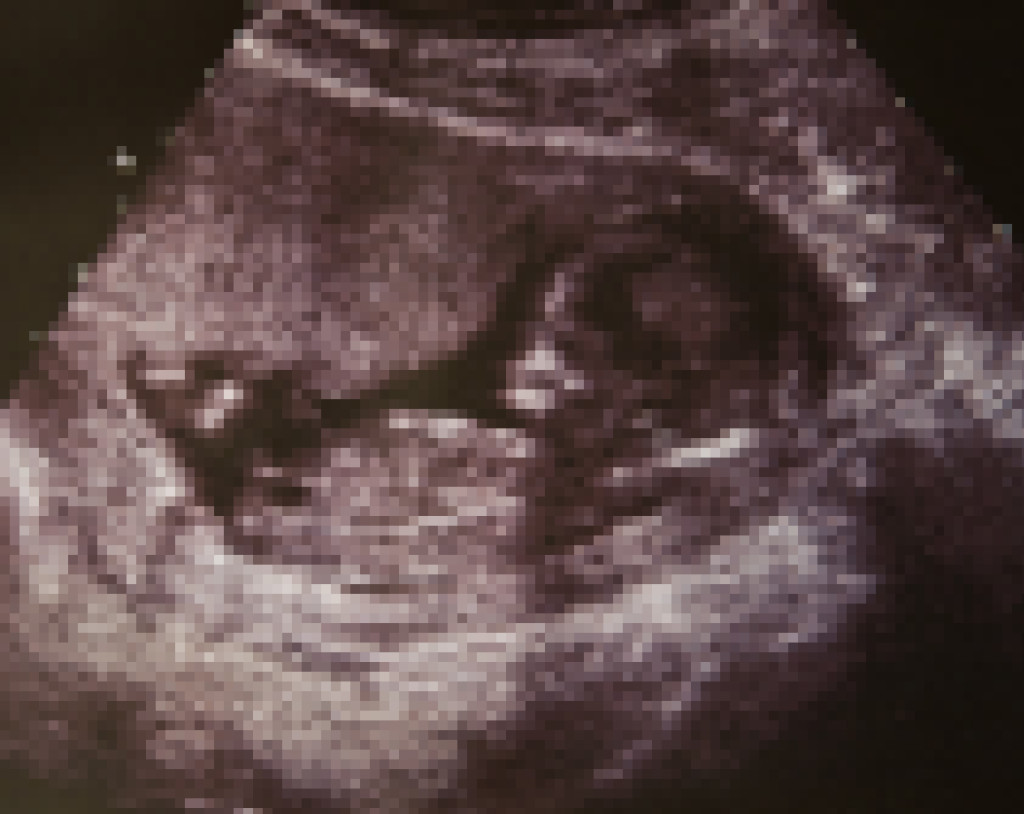 Pixelation of ultrasound image